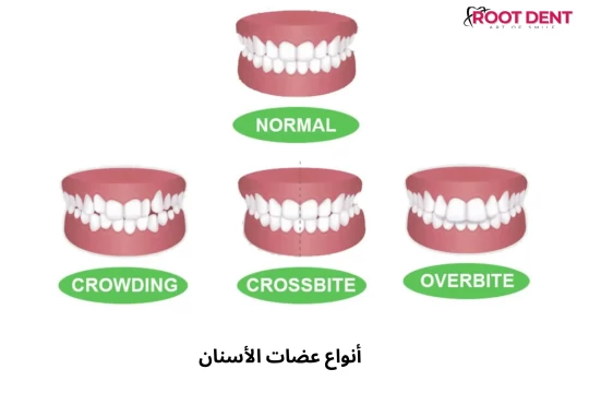 أنواع عضات الأسنان 2024