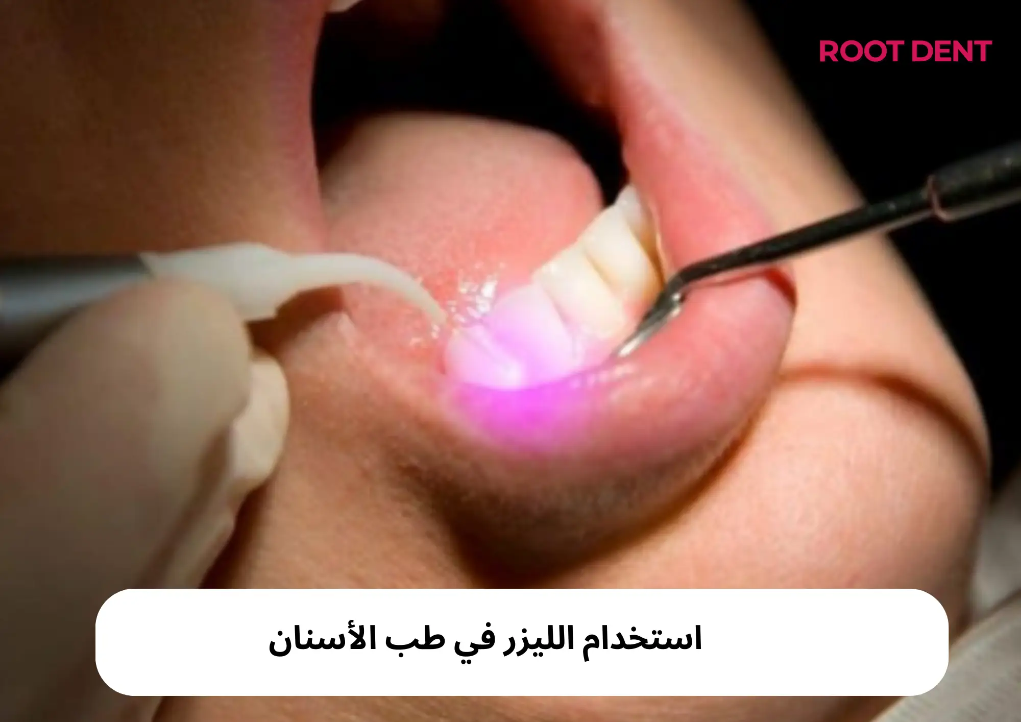استخدام الليزر في طب الأسنان