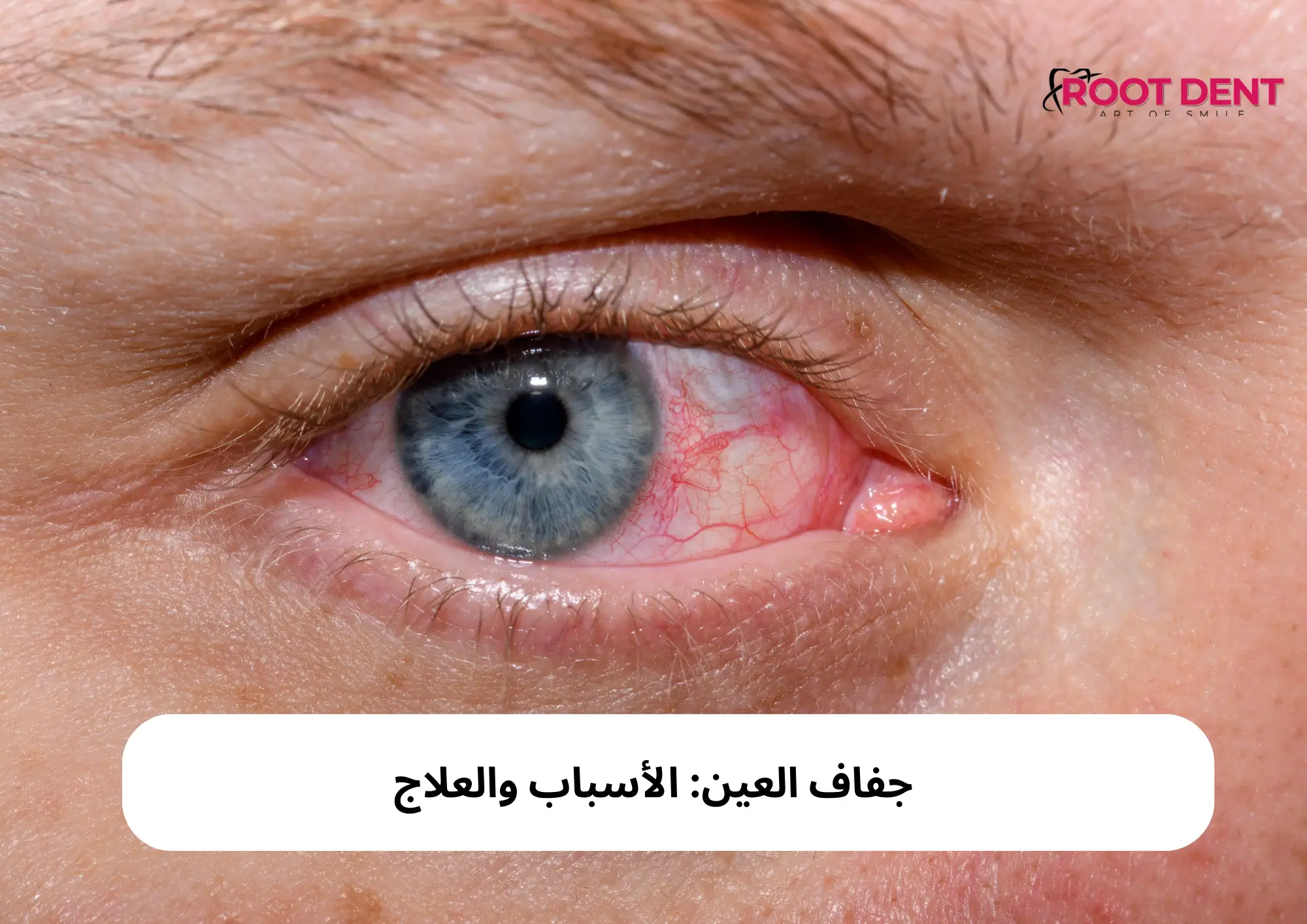 جفاف العين: الأسباب والعلاج