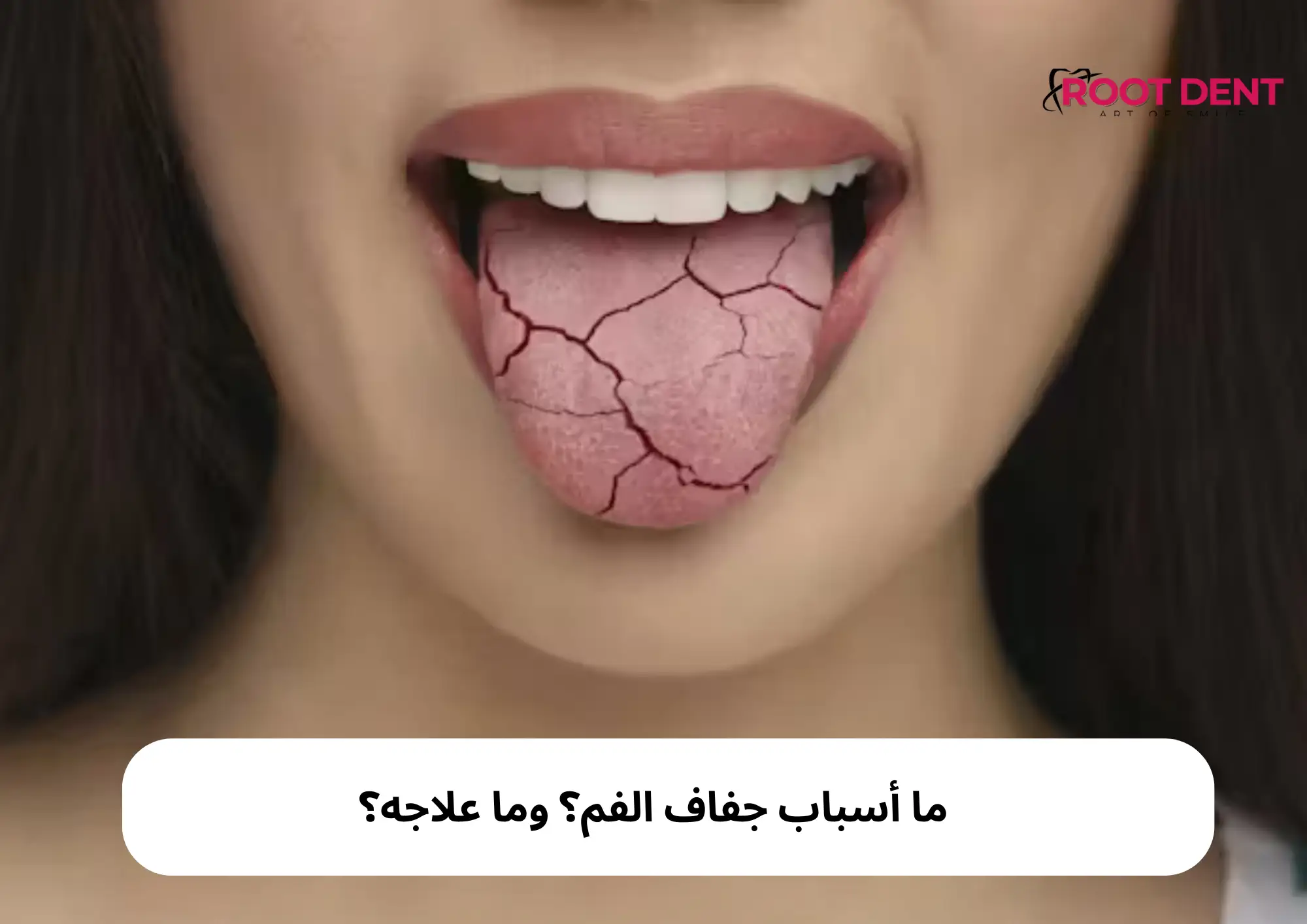 ما أسباب جفاف الفم؟ وما علاجه؟