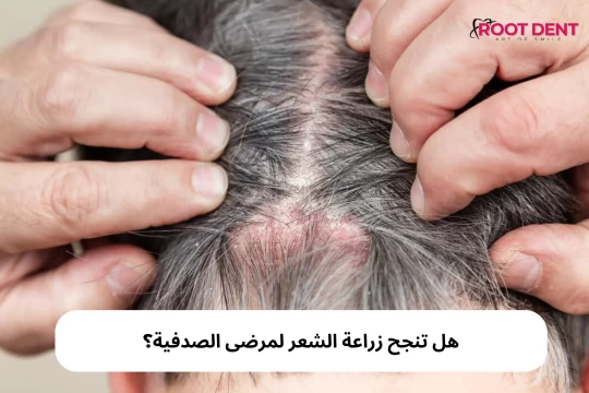 هل تنجح زراعة الشعر لمرضى الصدفية؟