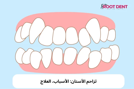 تزاحم الأسنان: الأسباب، العلاج