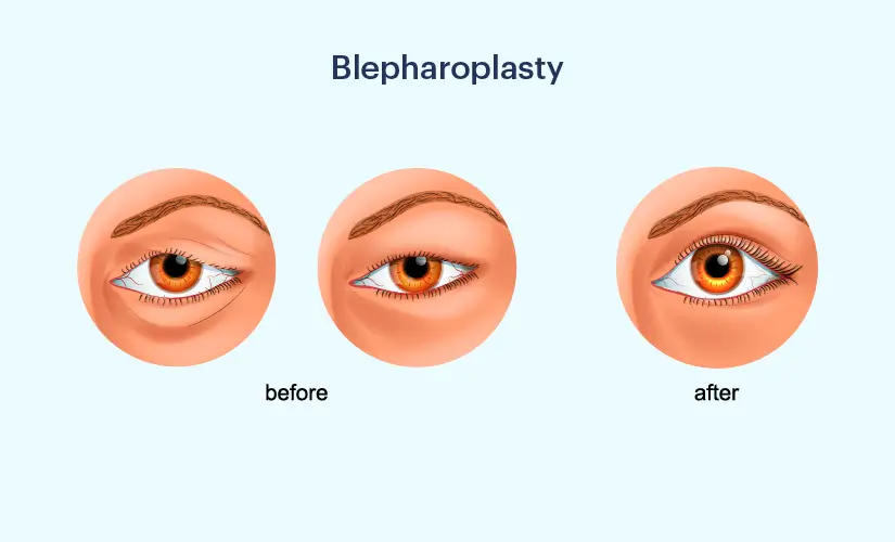 blepharoplasty (1)