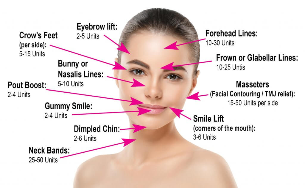 botox-facial-area-chart