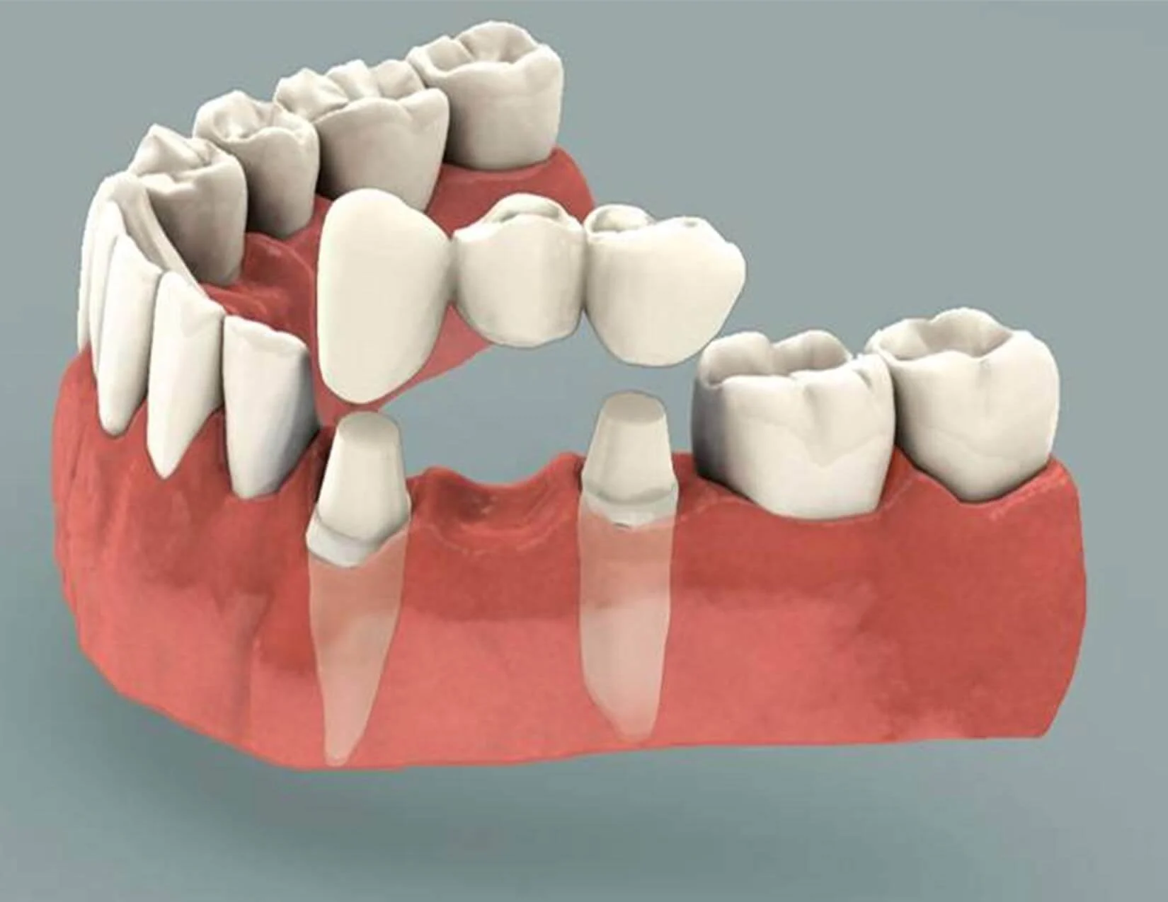 dental-bridges-1-1