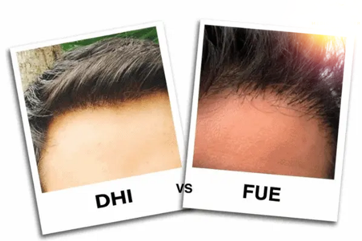 DHI-vs-FUE-Benefits-of-DHI-hair-transplant