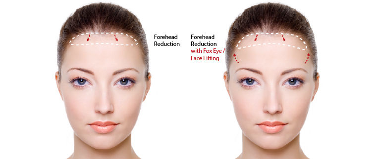 Forehead-Reduction-with-Fox-eye-and-or-Face-Lifting-Surgery-100