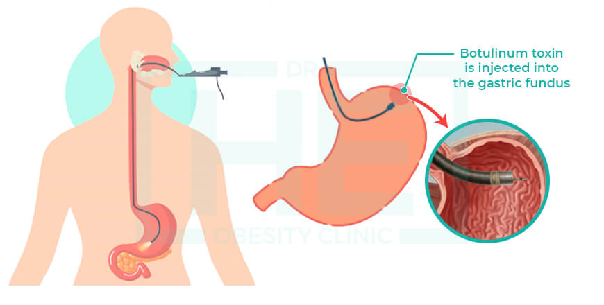 Gastric-Botox-in-Turkey-Price