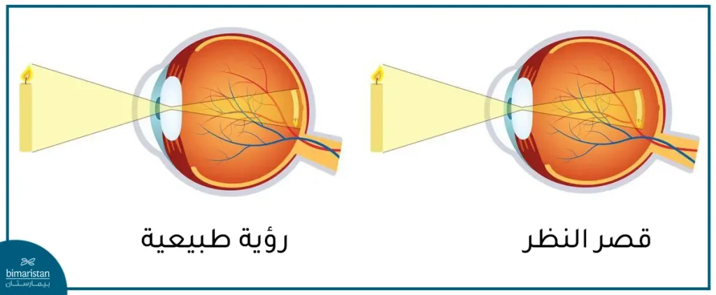 قصر-النظر-6-1024x422