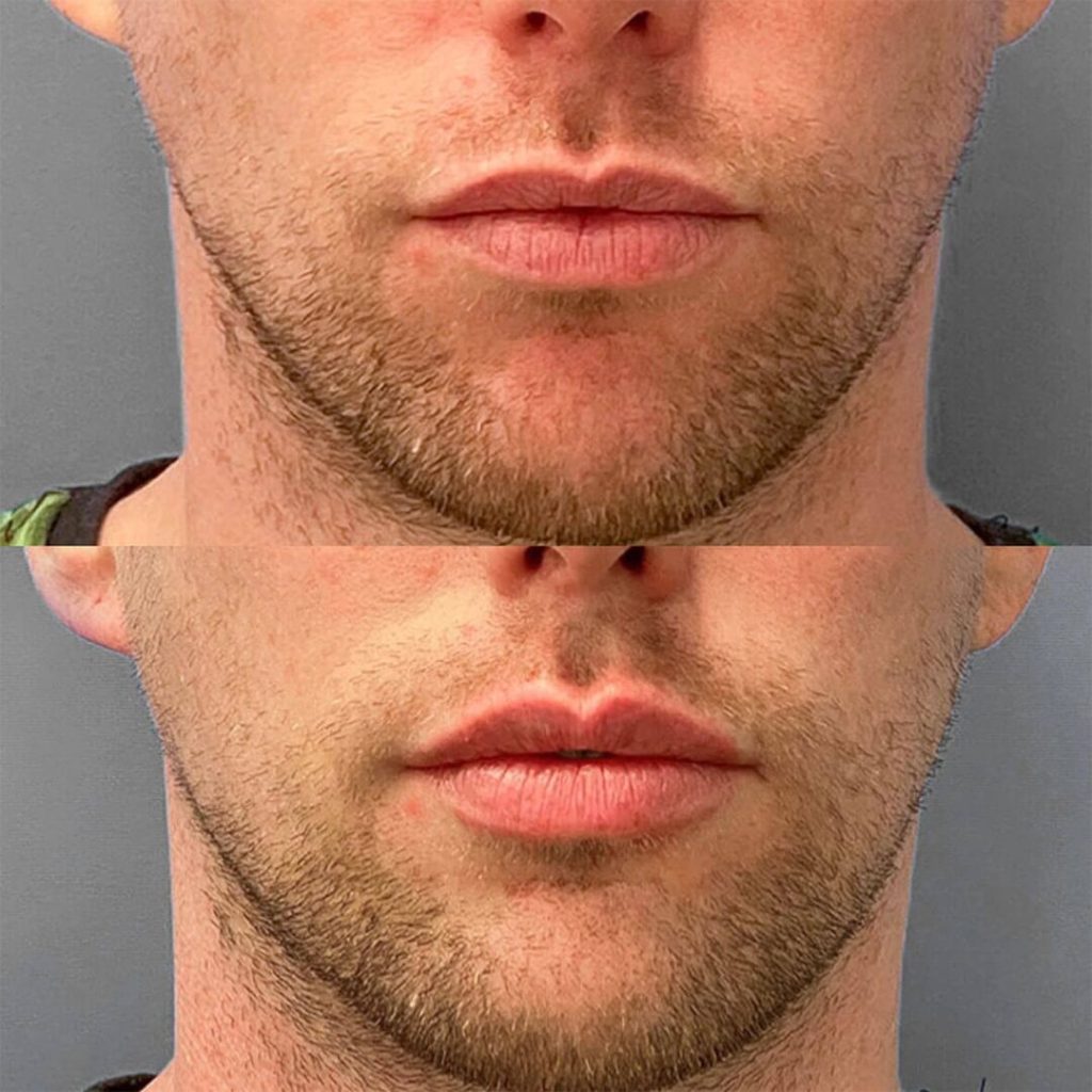 lip-filler-before-and-after-featured-1024x1024