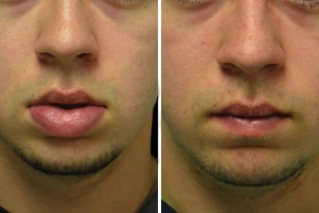 Lip-reduction-2-1