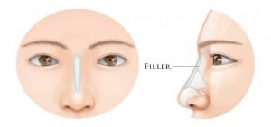 nose-filler-graphic-1024x536-1-300x141