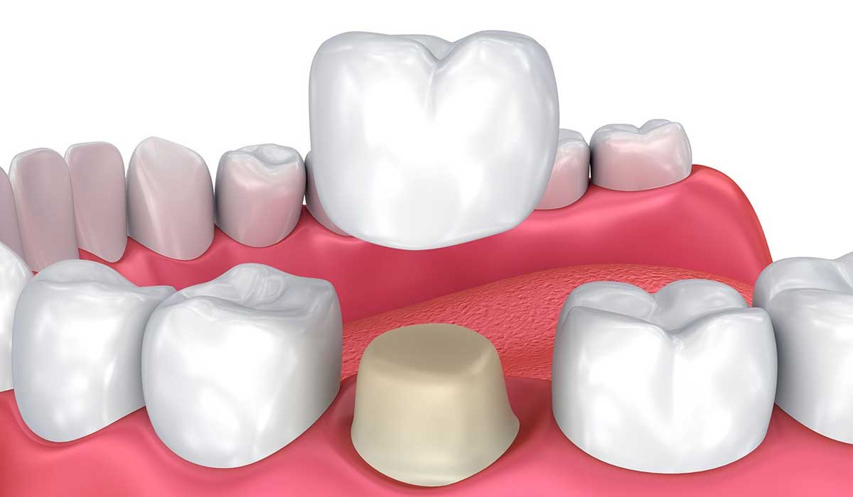 تلبيس الاسنان, الاسنان اللبنية,ماهي الاسنان اللبنية
