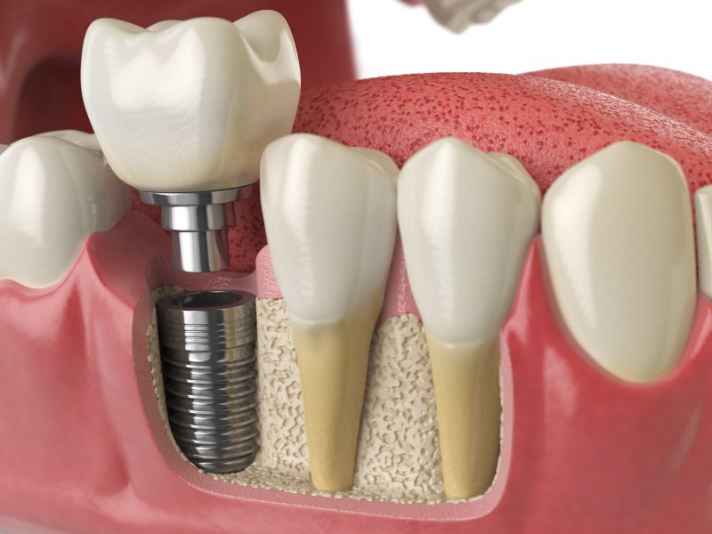 عملية زرع الاسنان, خطوات زراعة الاسنان, ما قبل زراعة الأسنان