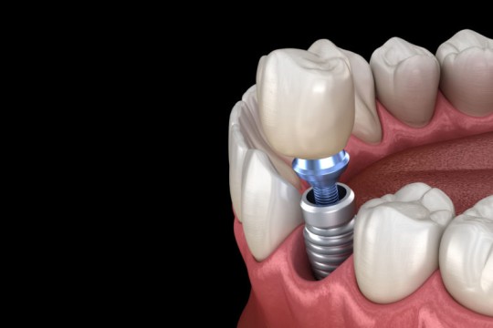 ما هي افضل انواع زرعات الاسنان 2024؟ هل الاسنان المزروعه تسوس ام لا ؟
