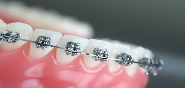 كم مدة تقويم الأسنان للحالات البسيطة ؟ ما هي أنواع تقويم الأسنان ؟