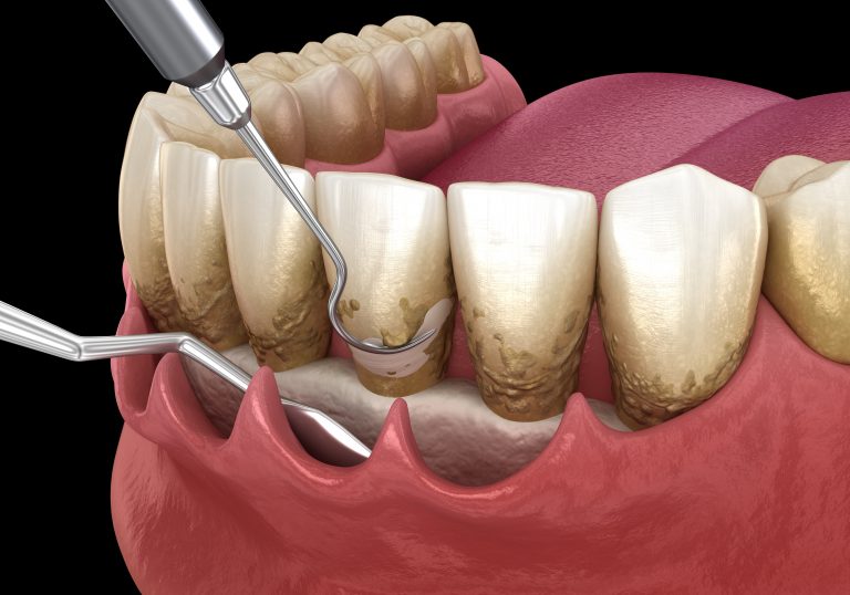 ما هي طريقة تنظيف الجير من الاسنان؟ كم مدة جلسة ازالة الجير من الاسنان ؟