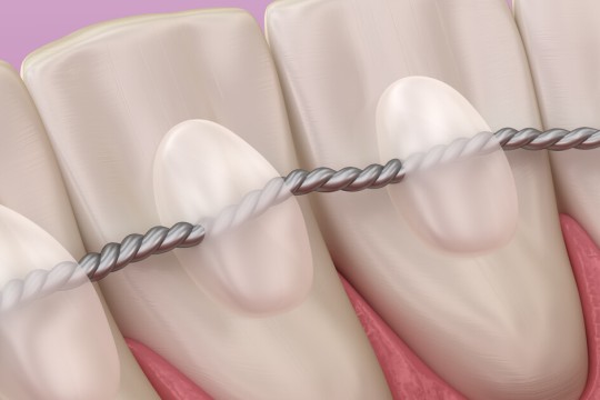 ما هو التقويم الثابت خلف الأسنان ؟ خطوات تركيب تقويم الاسنان