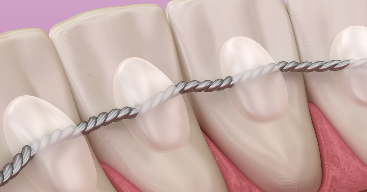 ما هو التقويم الثابت خلف الأسنان ؟ خطوات تركيب تقويم الاسنان