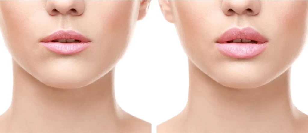 Skin-Science-Clinic-London-Lip-Fillers-1024x443