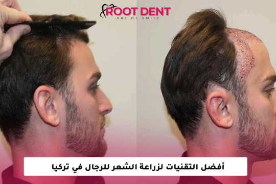 أفضل التقنيات لزراعة الشعر للرجال في تركيا