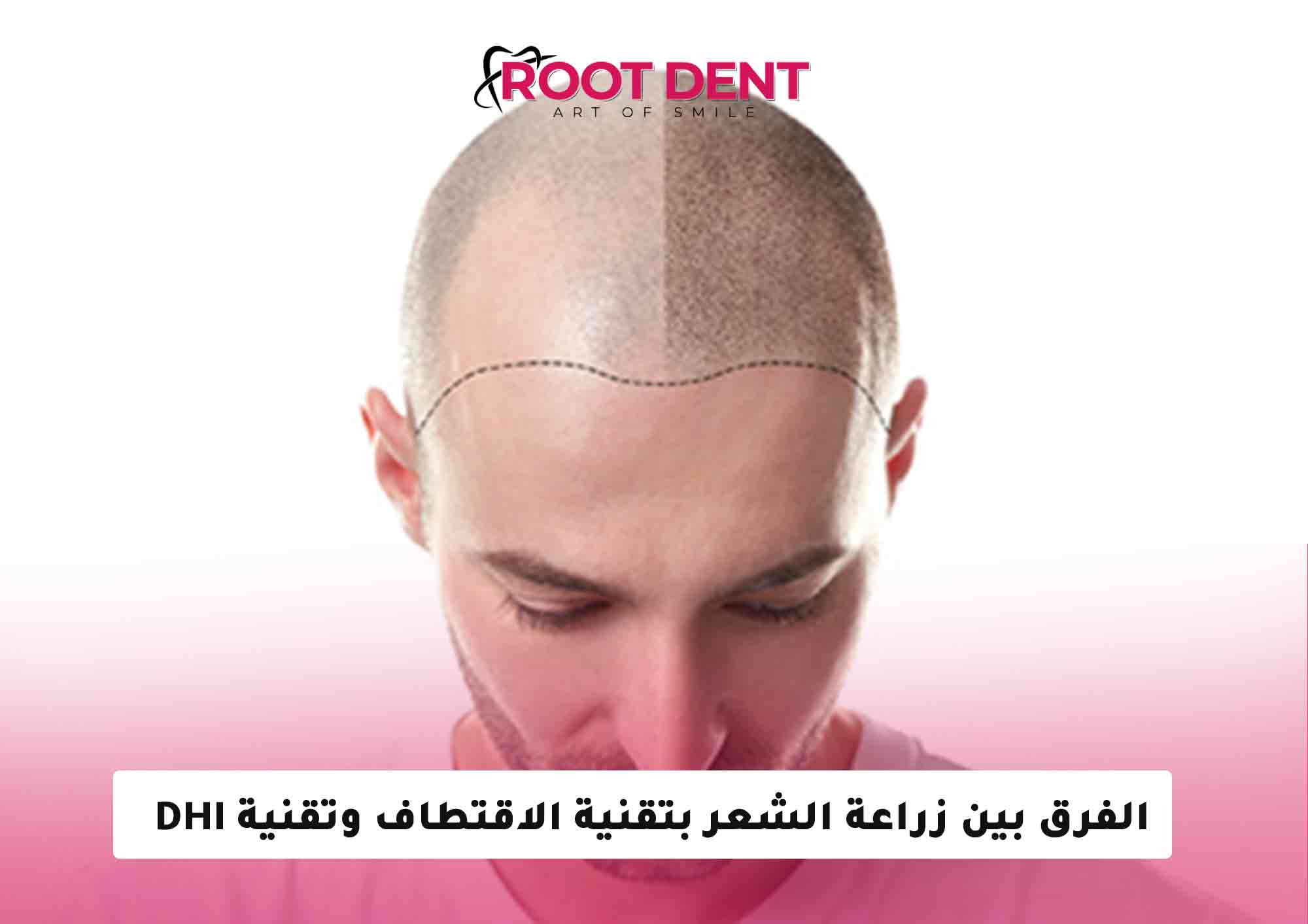 الفرق بين زراعة الشعر بتقنية الاقتطاف وتقنية DHI