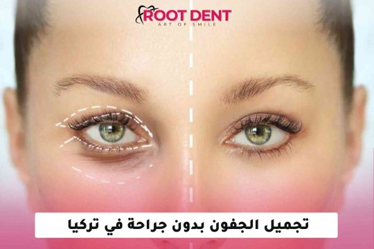 تجميل الجفون بدون جراحة في تركيا