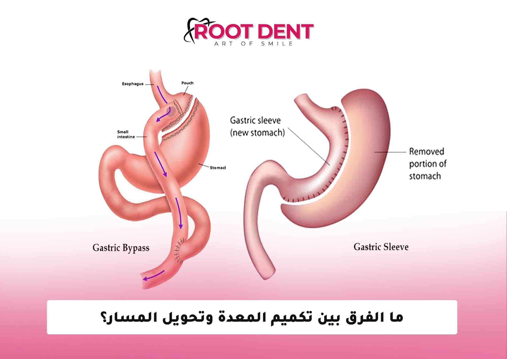 ما الفرق بين تكميم المعدة وتحويل المسار؟