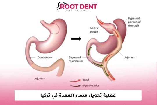 عملية تحويل مسار المعدة في تركيا