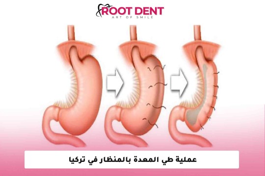 عملية طي المعدة بالمنظار في تركيا