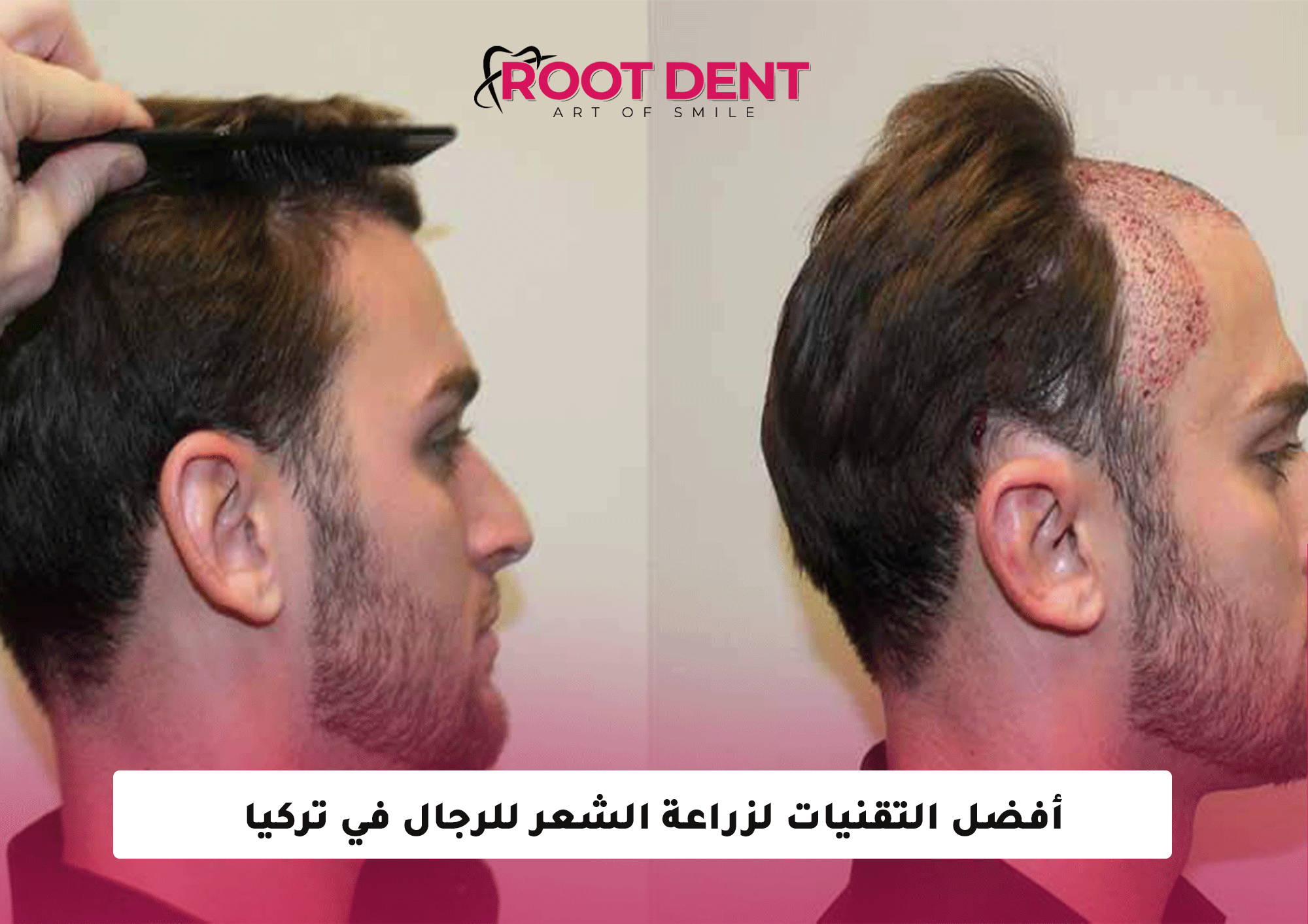 أفضل التقنيات لزراعة الشعر للرجال في تركيا