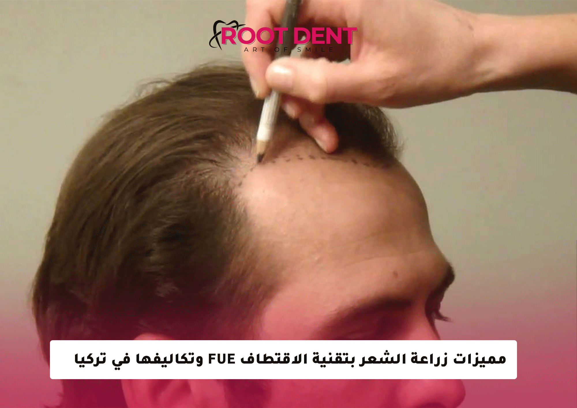 مميزات زراعة الشعر بتقنية الاقتطاف FUE وتكاليفها في تركيا